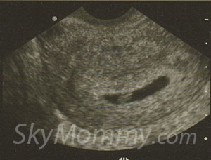 ultrasound 6w4dsw